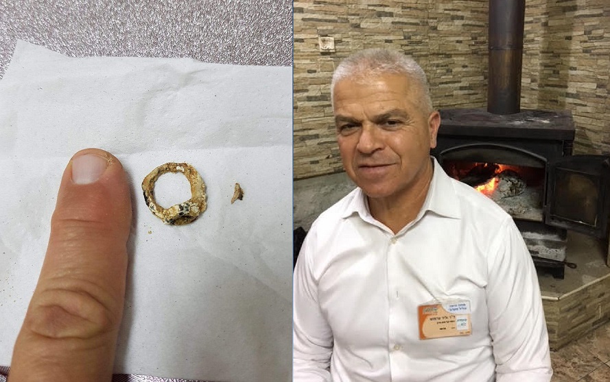 הטבעת שכבה באפה של ילדה שנתיים