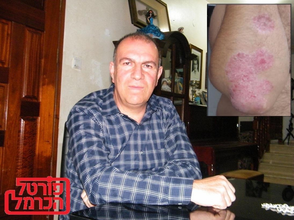 מחלת הפסוריאזיס סוגים גורמים וטיפול