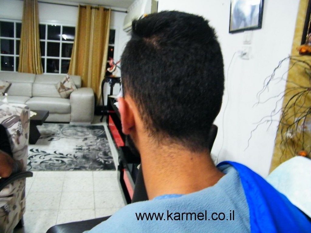 תחושת ערפול מוחי בקרב חולים עם תת פעילות של בלוטת התריס