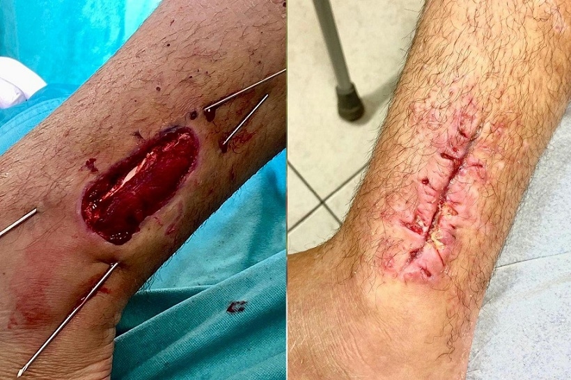 שיטת טיפול בפציעות עור החוסכת השתלת עור