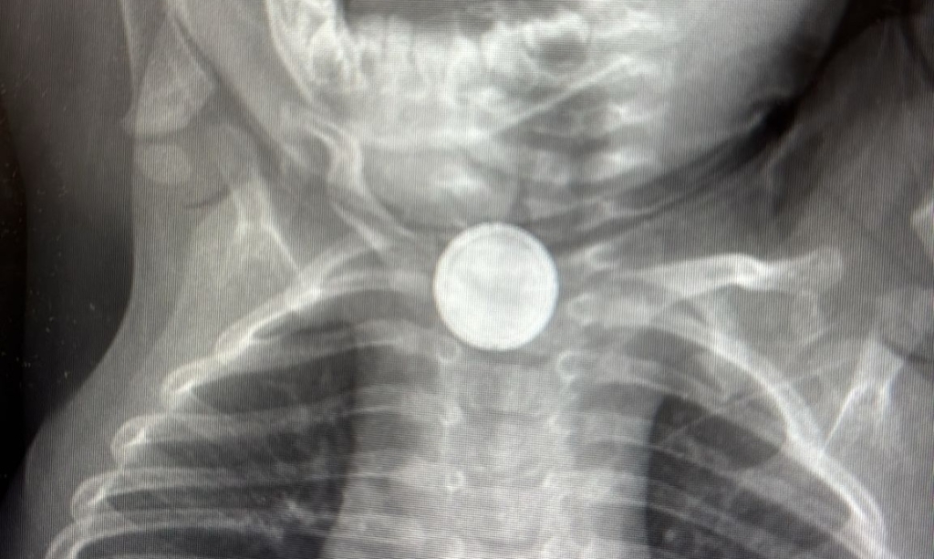 כך ניצלו חייו של תינוק בן שנה וחצי שבלע סוללה