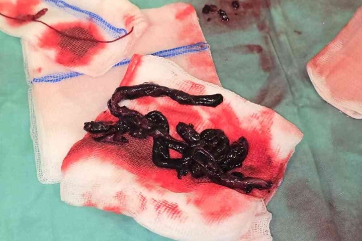 קרישי דם ענקיים מסכני חיים בעורקי הריאה