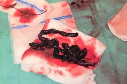 קרישי דם ענקיים מסכני חיים בעורקי הריאה