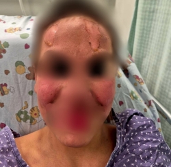 נער בן 13 אושפז עם כוויות קשות