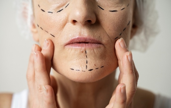 מילוי קמטים בפנים המדריך המלא לטיפול שמחזיר את הנעורים